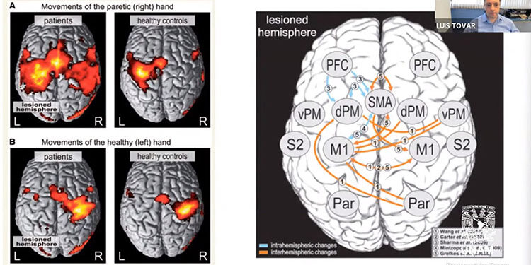 Estudian cómo infarto cerebral modifica las conexiones neuronales  