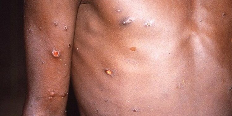 Viruela del mono: ¿Cómo prevenir el contagio?
