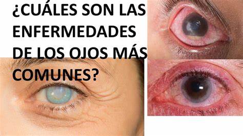 ¿Qué es el síndrome de ojo seco?