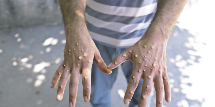 No da tregua la viruela del mono en la Isla | Agencias