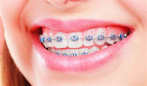 ¿Por qué elegir Brackets inteligentes para un tratamiento más cómodo?