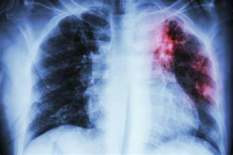 Disponible en México primera terapia recomendada por los expertos que cambiará la vida de pacientes con Fibrosis Pulmonar Progresiva
