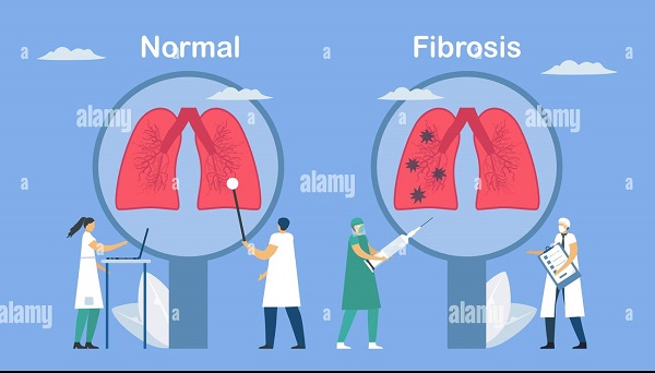 Esclerodermia: enfermedad desconocida que endurece la piel y cicatriza los pulmones
