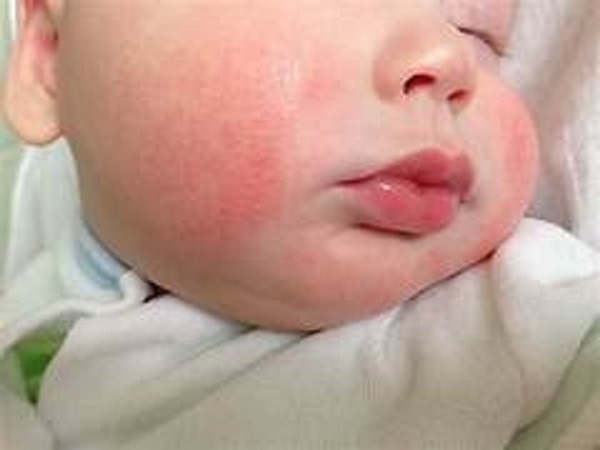 Psoriasis Pustular Generalizada: enfermedad desconocida, grave y potencialmente mortal.