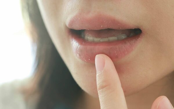 Deshidratación: ¿Cómo el calor puede provocar problemas de salud bucal?