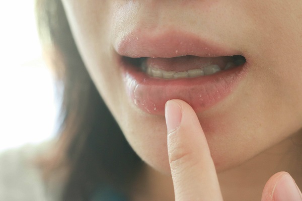 Deshidratación: ¿Cómo el calor puede provocar problemas de salud bucal?