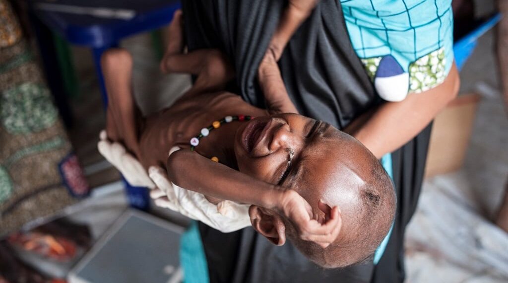 A young baby suffering from severe acute malnutrition cries during an inspection at one of the Unicef nutrition clinics in the Muna informal settlement.
