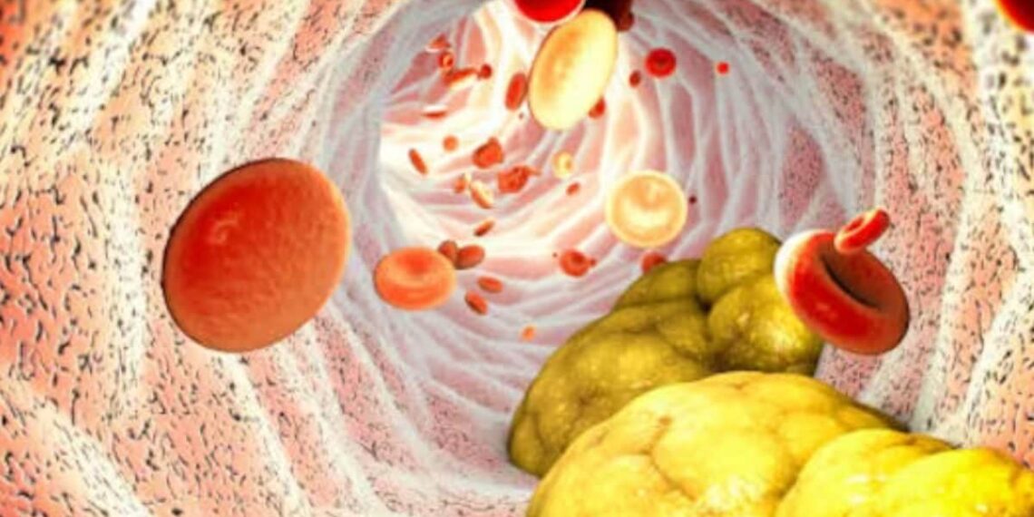 Ghee To Red Meat, 5 Foods You Must Avoid To Keep Cholesterol In Check
