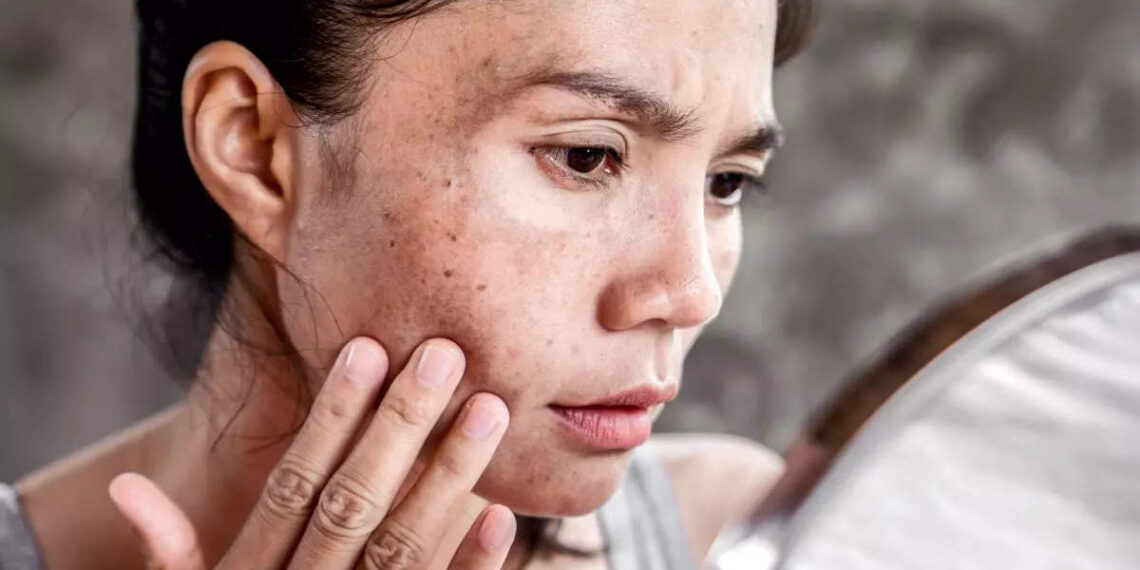 Eating these foods can reduce skin pigmentation