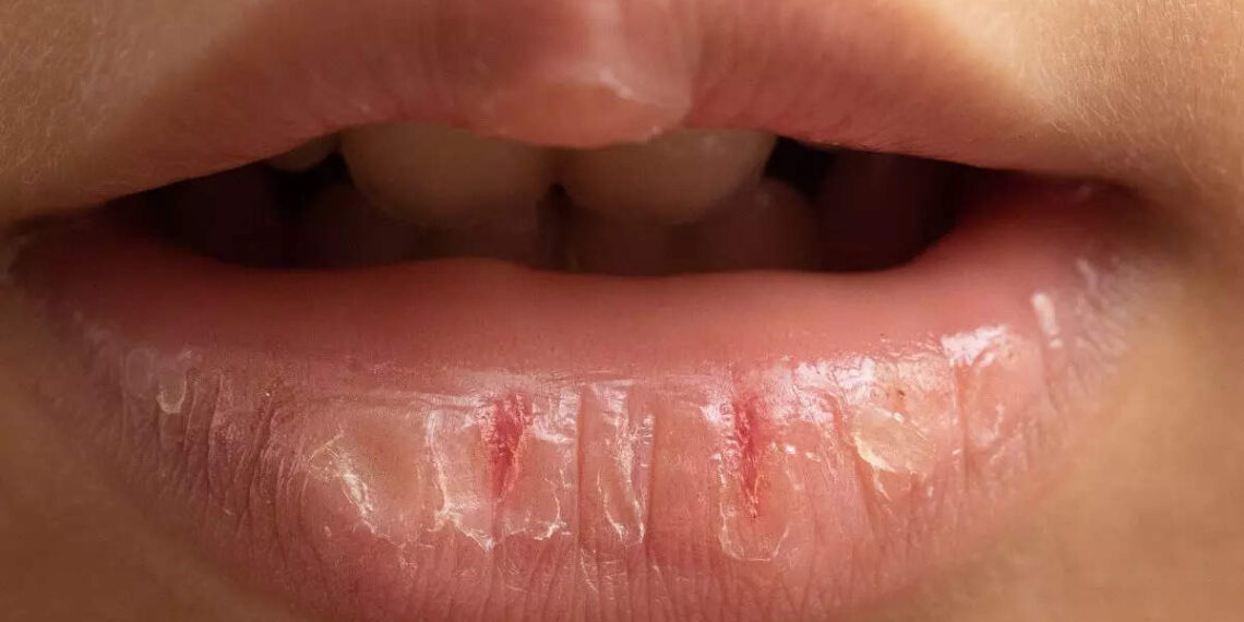 6 Foods to prevent and heal dry, chapped lips