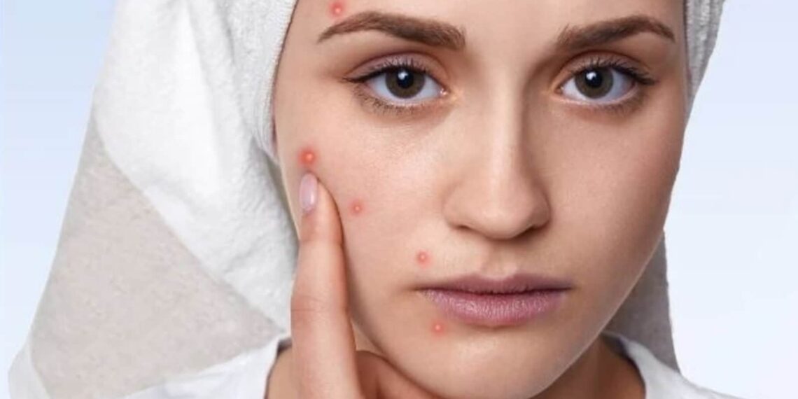 Here's what to eat you have breakouts