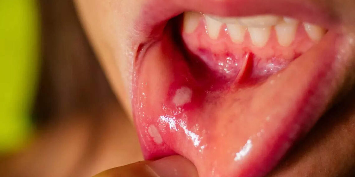 5 common foods that can trigger mouth ulcers