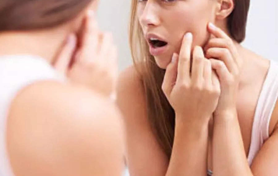 Worst Food For Acne: Acne Causing Foods You Need To Avoid