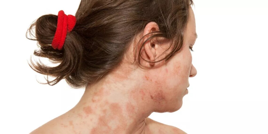 Four of the best foods to add to your diet to help control eczema