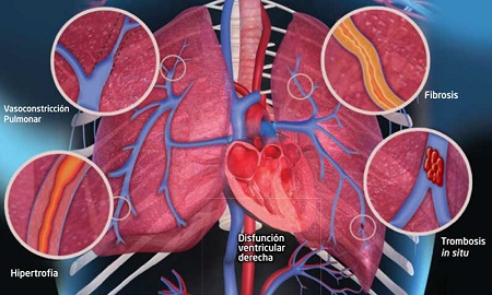 Se exhorta a la secretaria de salud a intensificar la atención a pacientes con hipertensión pulmonar