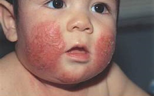 Convocan a taller gratuito en línea el 29 de enero a las 19:00 sobre Dermatitis Atópica, enfermedad que afecta a 1 de cada 10 mexicanos