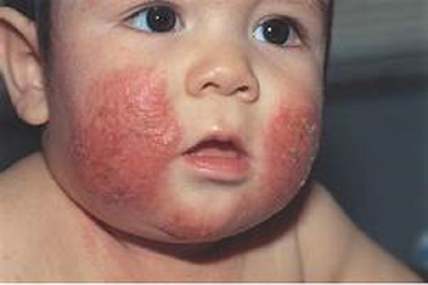Convocan a taller gratuito en línea el 29 de enero a las 19:00 sobre Dermatitis Atópica, enfermedad que afecta a 1 de cada 10 mexicanos