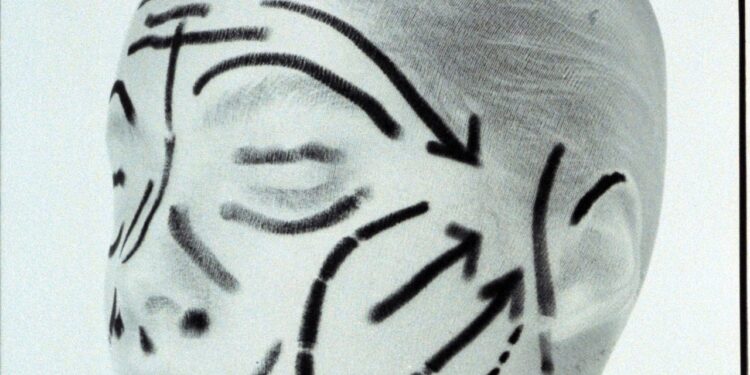 A Deep-Plane Facelift at 40: One Woman's Story