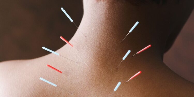 The Benefits of Acupuncture, From Stress Relief to Facial Balancing