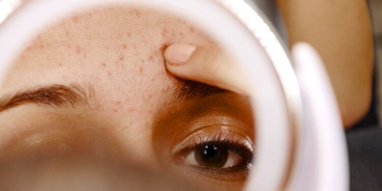 It’s Not a Whitehead, It’s Milia—Here's How to Treat It