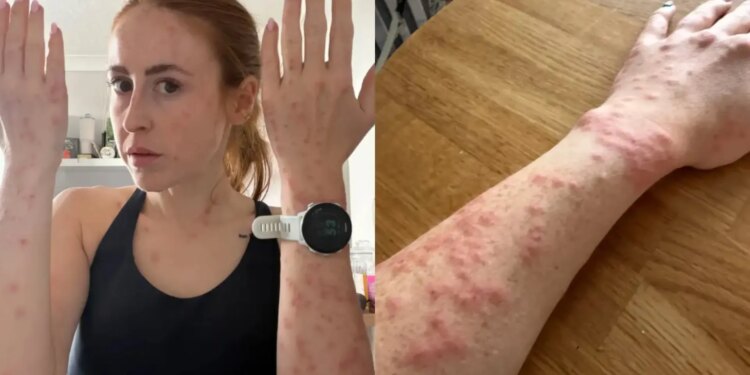 La terrible experiencia de una 'influencer' de viajes en un hotel infestado de chinches: "Me desperté con picazón"